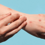 Monkey pox Cases Surge across Sindh, Raising Alarm among Health Officials