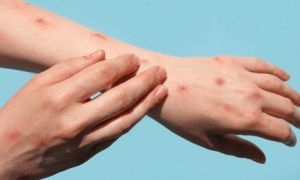 Monkey pox Cases Surge across Sindh, Raising Alarm among Health Officials