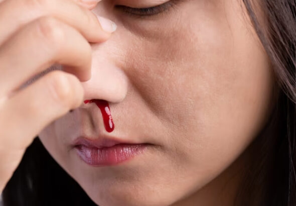 nosebleeding-in-summer-Main